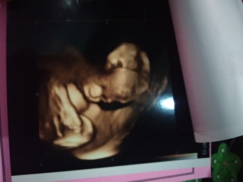 Bun saya mau tanya? Saya sudah 7bulan kok pergerakan bayi nya kurang bergerak atau kurang lincah ya?