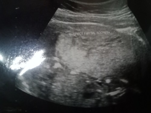suspect partial Accreta แปลว่าอะไรค่ะ ในใบอัลตร้าซาวด์ แม่ๆคนไหนพอจะทราบมั้งค่ะ