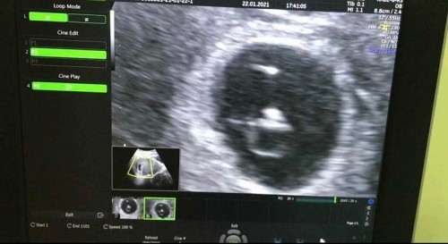 ท้องแรก! เกือบไปแล้วลูกแม่!!