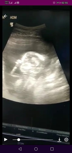 16 week.3day.เหมือนในนี้มันจะลงVDOไม่ได้เลยแคปมา