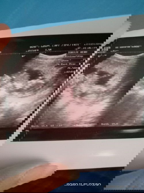 Bunda mohon bntuannya usia kehamilan 25 minggu