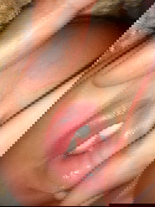 เป็นติ่งๆใต้ลิ้น