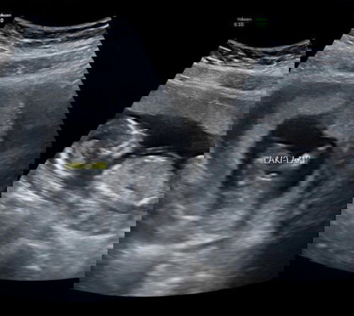 Kalo Jenis kelamin di usia 15w sudah keliatan apa benar sudah fix?