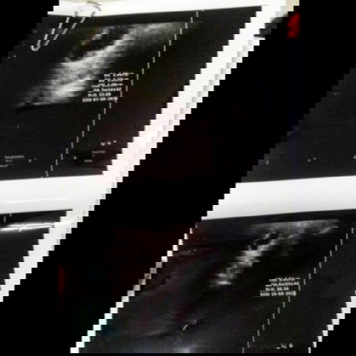 ประสบการณ์ขูดมดลูก21/1/64