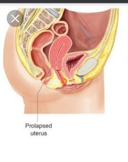 Benjolan di Vagina Atas Agak Dalam