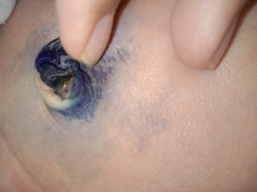 แบบนี้ใช่หนองมั้ยค่ะ พอดีแม่นอน รพ อยู่สามวันฝากย่าเขาเลี้ยงไว้