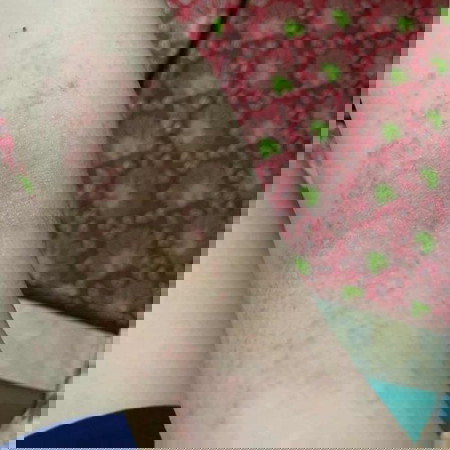 RASHES π²π²π²π²