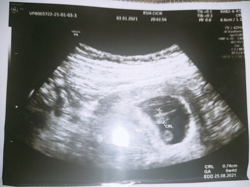 Kenapa USG sama perkiran bidan berbeda, kalo USG 10 Wek kalo bidan 15 Wek, kenapa bisa seperti itu