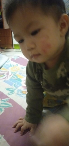 วิธีรักษากากน้ำนม