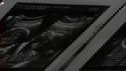 JK janin dan berat janin