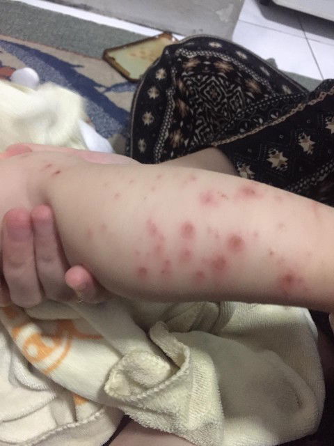 Menghilangkan bekas flu Singapura