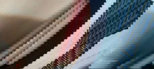 Ruam pada leher bayi