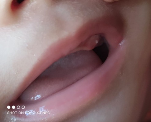 White spots on baby's teeth