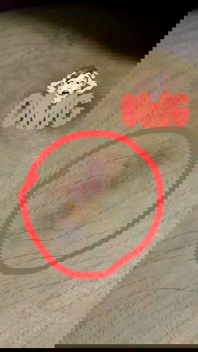 อยู่ดีๆก็มีรอยช้ำแบบนี้ค่ะไม่ได้เดินชนอะไรเลยค่ะมันเป็นของมันเองเกิดจากอะไรคะ