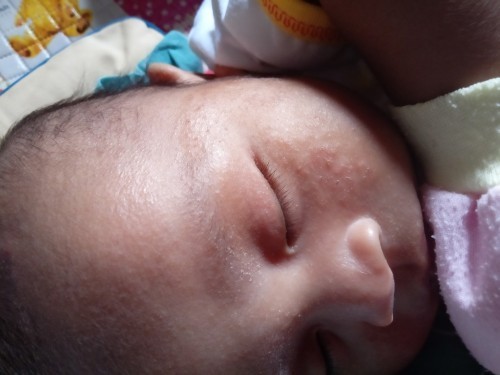 Minta solusi bunda bunda
Bun anak aku beruntusan diwajah kemaren udah sembuh sekarang ada lagi, kira