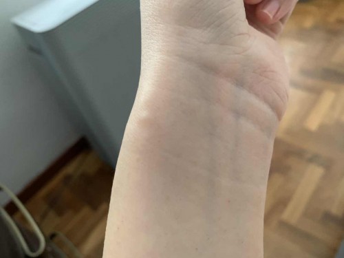 Wrist injury