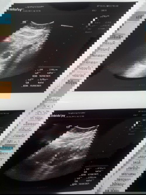 ในภาพอัตเตอร์ซาว
ดูยังไงว่ามีการเต้นของหัวใจครับ