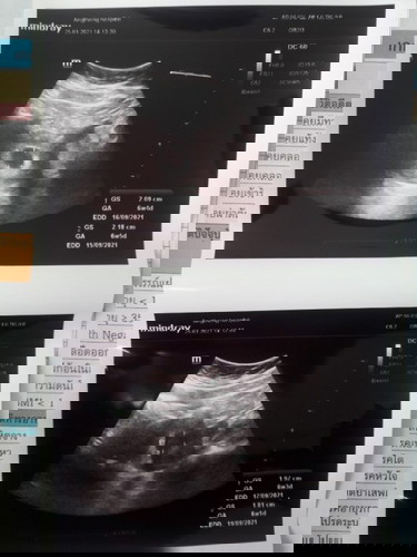 ในภาพอัตเตอร์ซาว
ดูยังไงว่ามีการเต้นของหัวใจครับ