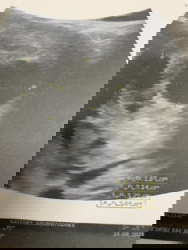 9สัปดาห์6วัน อัลตราซาวด์ทางหน้าท้องไม่เจอตัวอ่อน ท้องลมไหมคะ