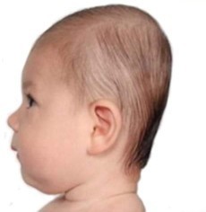 Kepala bayi lonjong dan datar usia 3 bulan apa masih bisa diperbaiki?