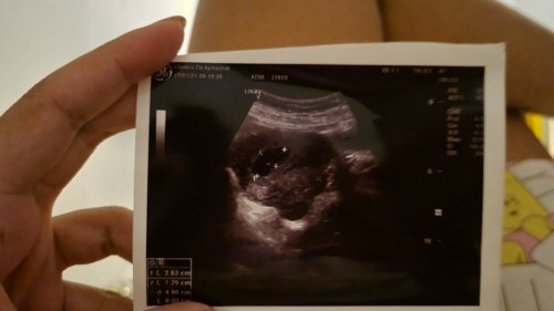 ไม่ทราบว่า นานมั้ยคะ ?กว่าจะแท้งธรรมชาติ (( ถ้าหากว่าท้องลม ))