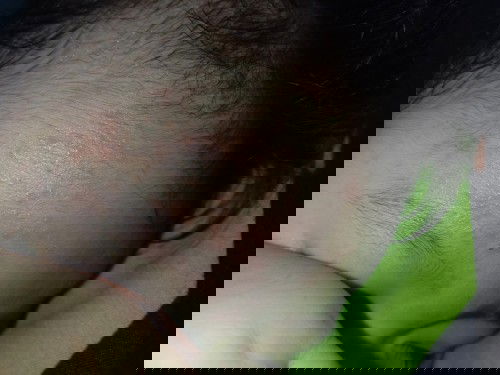 Bintik merah di wajah bayi