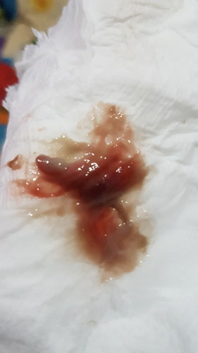 เมื่อวานหลังจากโดนกระตุ้นปากมดลูกมา