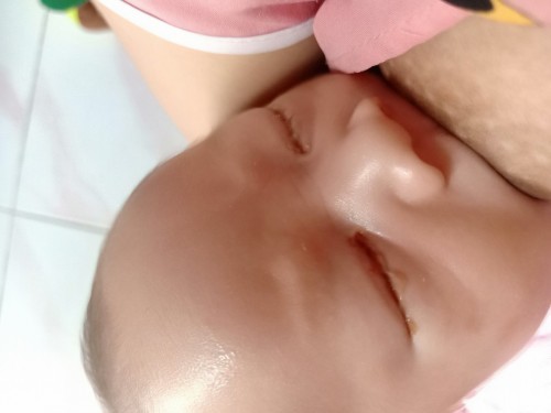 Bé được 16 ngày tuổi bị như vậy có sao hk ạ