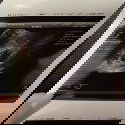 คุณหมอบอกน้องไม่สมบูรณ์ ไม่มีพัฒนาการ