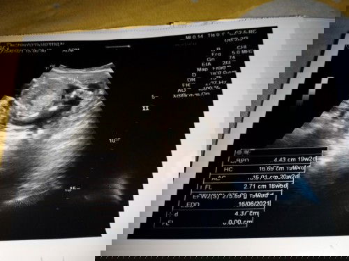 20w แม่ๆบ้านไหนดูเห็นไหมค่ะ
ว่าผู้หญิงหรือผู้ชาย?👦👧
เราดูไม่เป็นหมอก้อไม่ได้บอก