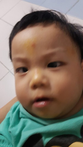 ผื่นแบบนี้เป็นอะไรคะ