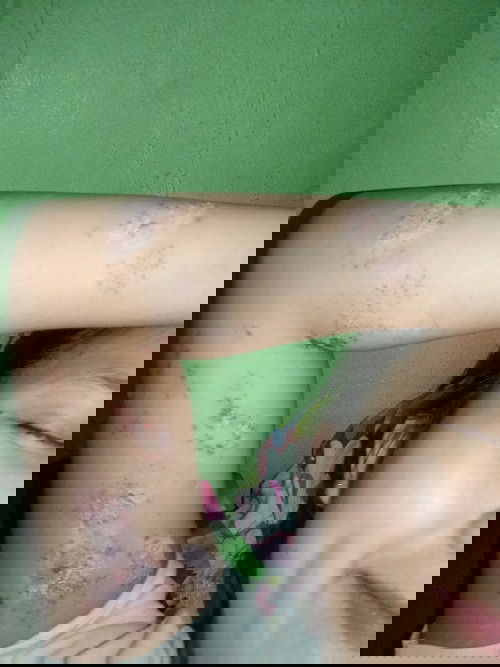 Herpes ditangan kiri