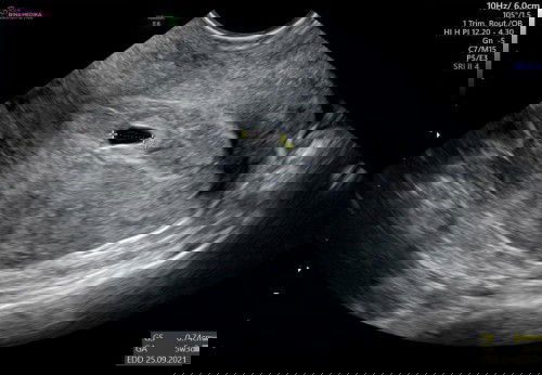 Flek implantasi atau tanda keguguran?