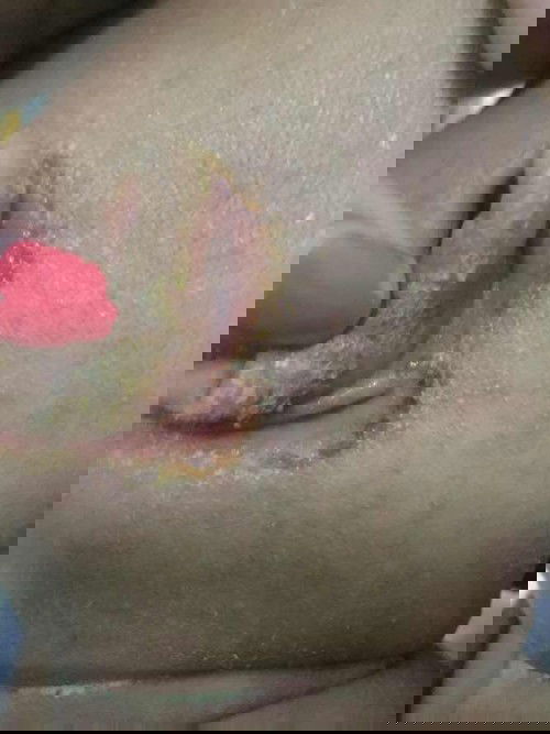 ใช้ยาอะไรทาดีคะ????