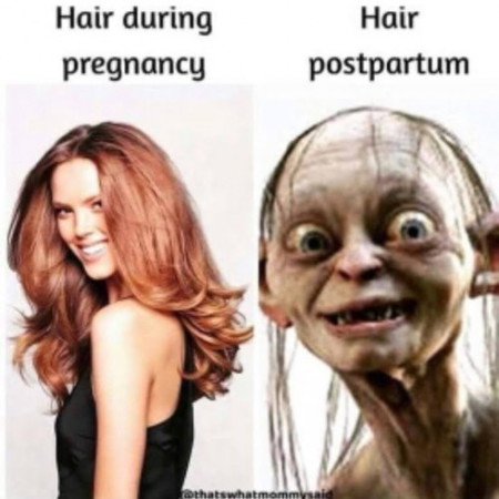 Postpartum hairfalls