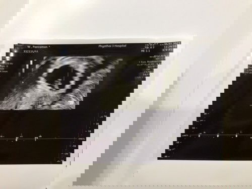 8 สัปดาห์ หมอบอกน้องตัวเล็กไป