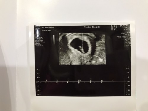 8 สัปดาห์ หมอบอกน้องตัวเล็กไป