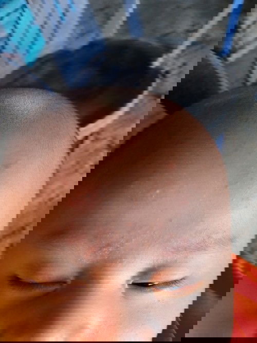 Bé nhà e đc 2m12d r mà trán vs chân mày bé cu2s bị chầy và đỉ nên lm sao h các m ơi