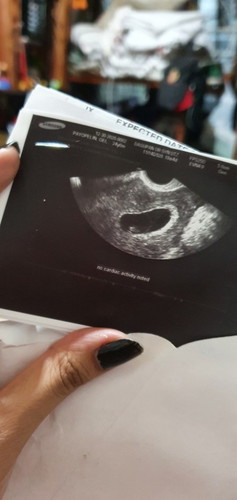 10weeks preggy No heartbeat