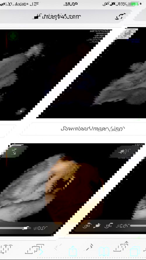 Bbj bayi usia 35 week