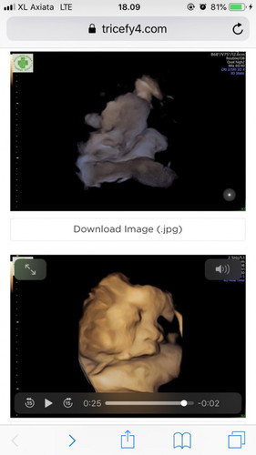 Bbj bayi usia 35 week