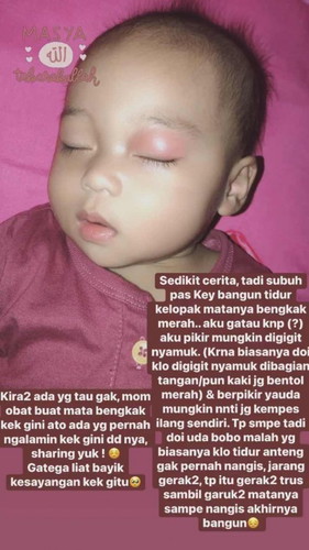 Kelopak mata bayik bengkak !!