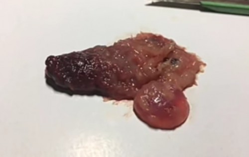 แท้งแบบไม่รู้ตัว 😢