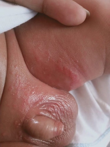 help po .. diaper rash