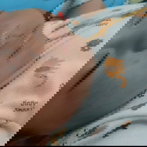 Bintik merah pada pipi bayi