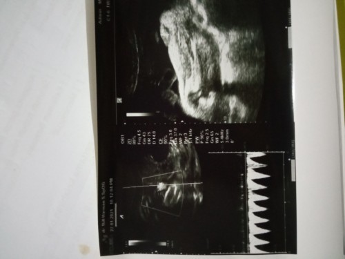 USG usia kehamilan 7bulan dan 8bulan do'a kan aku dan bayi ku selalu sehat ya bunda2 terimakasih 😊