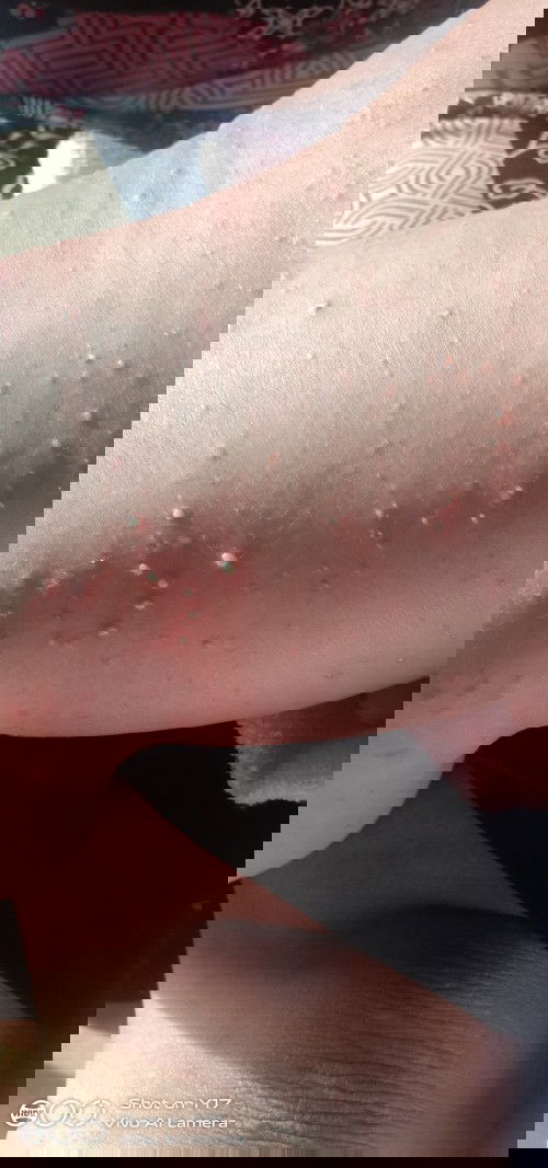 bintik bernanah pada kulit bayi