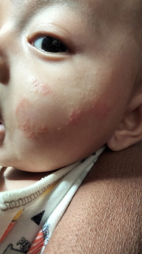 Mom ad yg tau in ap dipipi anak ak, kata org si gara2 kena asi tapi setiap habis asi selalu di lap
