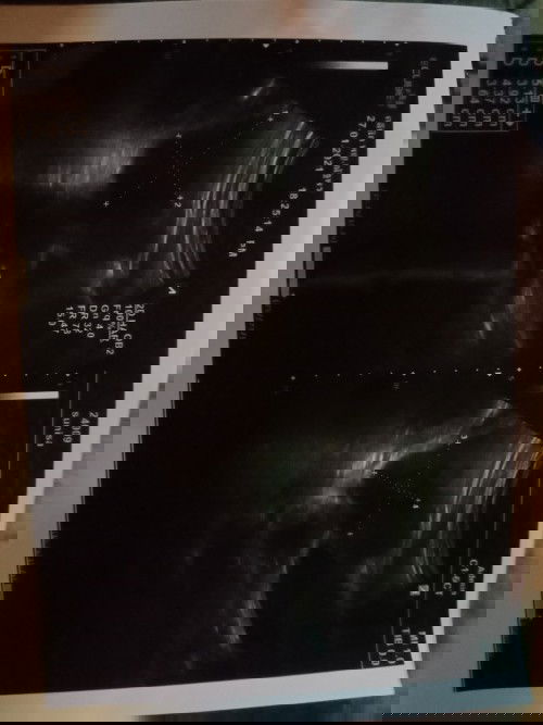 หมอบอกเราหน้าจะท้องนอกมดลูกไปอัลตร้าซาวด์เห็นเป็นก้อน 2 ซ้ายขวา แต่เราไม่มีอาการอะไรเลย