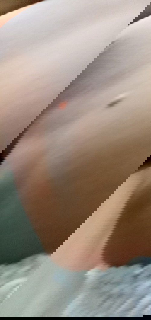 ada kutil di perut bayi